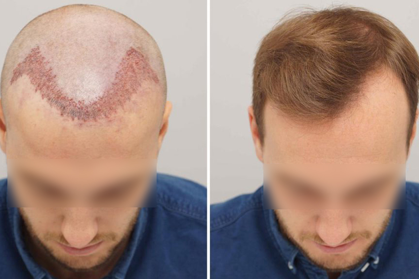 Hair Transplant