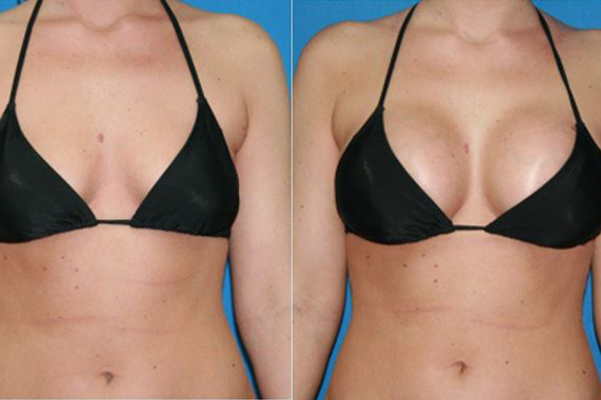 Breast Implants (Augmentation)