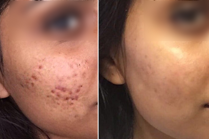 Acne Scar Treatment
