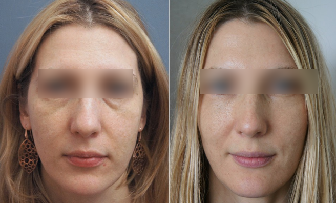 Baggy Eyelids/Blepharoplasty