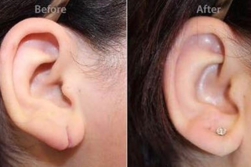 Ear Lobule/Wide Hole Surgery