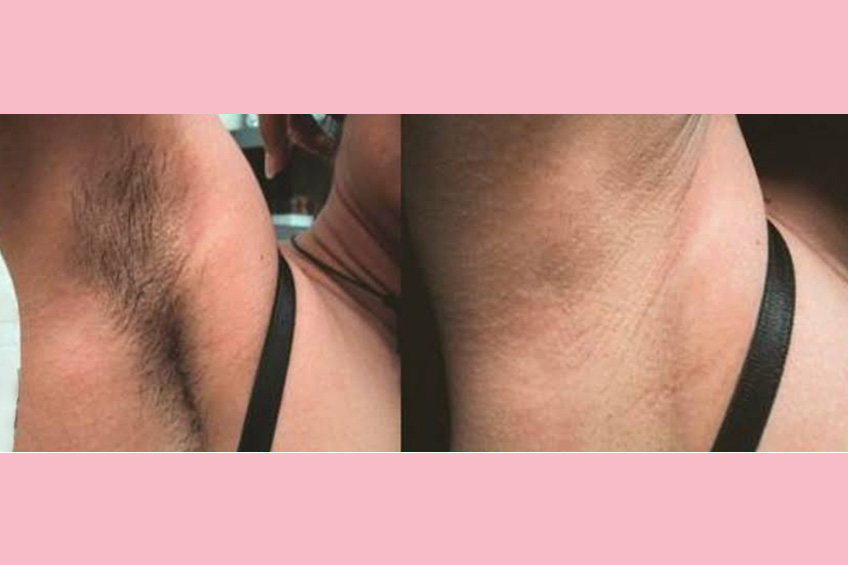 Permanent Hair Removal
