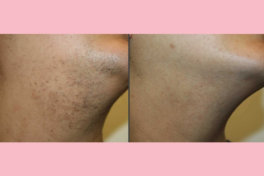Permanent Hair Removal