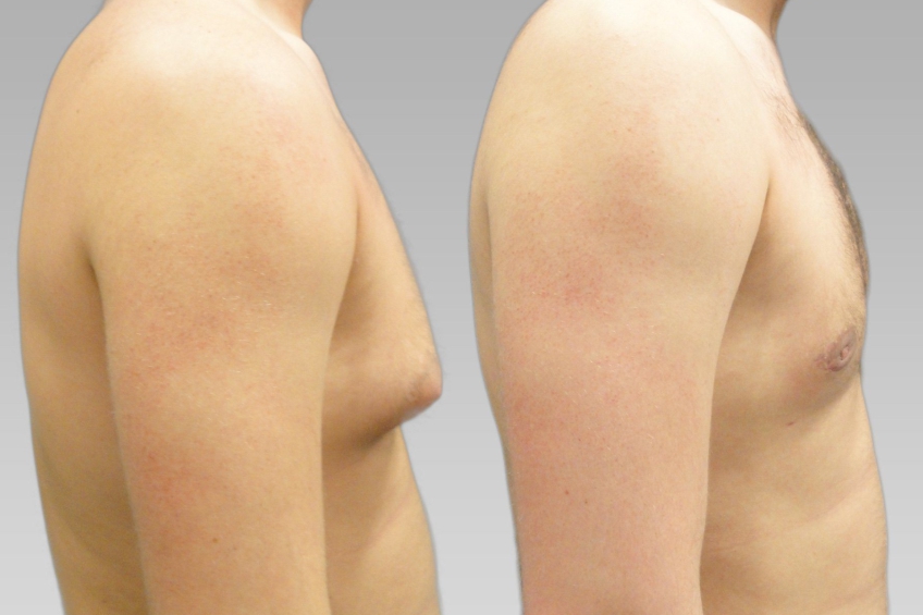 Male Breast Reduction Gynecomastia