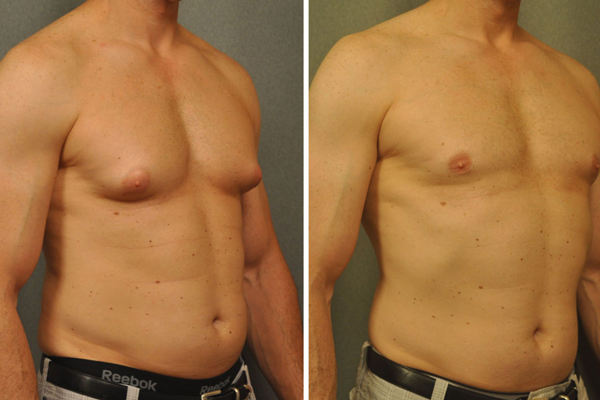 Male Breast Reduction Gynecomastia
