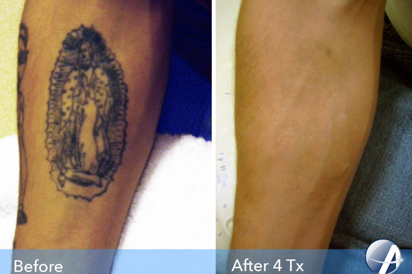 tattoo removal