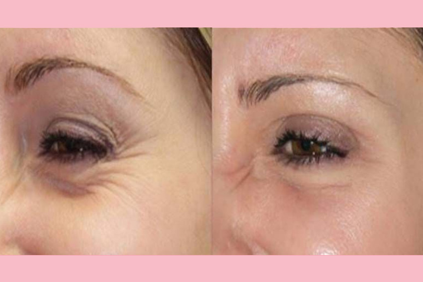 Wrinkle treatment / Rejuvenation / Peels